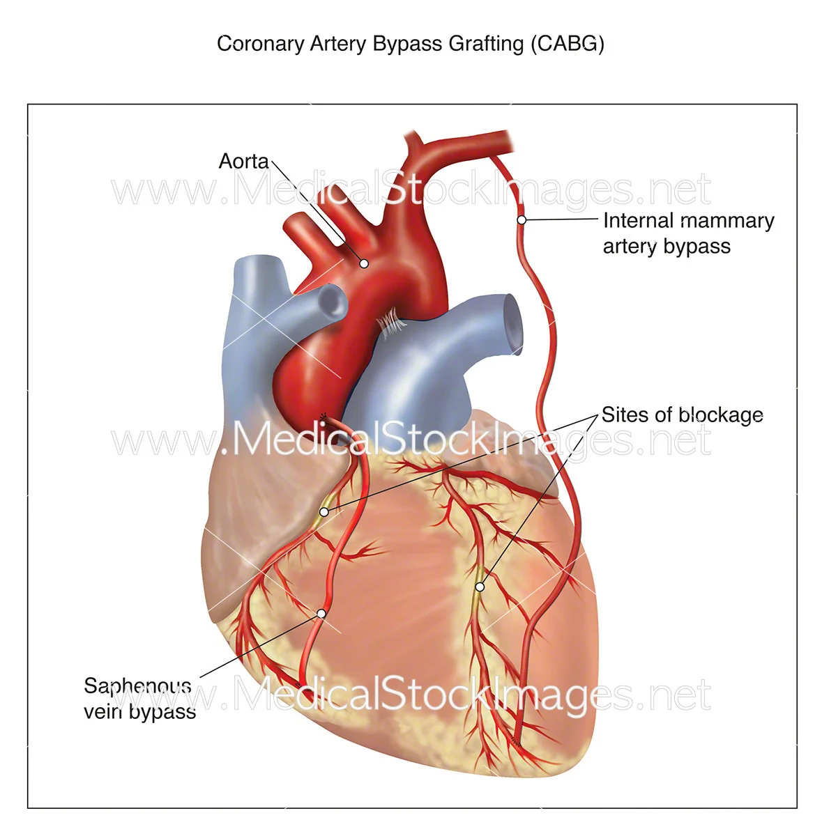 11536-coronary-artery-bypass-grafting-PV