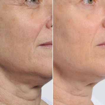 neck_before_and_after_3